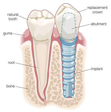 what is a dental implant explained